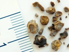 Новое звуковолновое устройство позволит разрушать камни в почках без операции