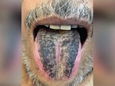 После перенесенного инсульта язык мужчины из Индии стал черным и мохнатым