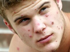 Почему текущей вспышки обезьяньей оспы не следует бояться