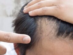 В США официально одобрили первое в своем роде лекарство от облысения