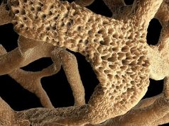 Российско-иранский препарат эффективно вылечит остеопороз