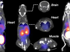 Радиоактивная фруктоза оказалась удобным индикатором рака и воспалений