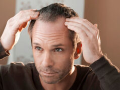 Выпадение волос удалось остановить с помощью новых микроигольчатых пластырей