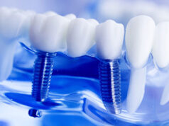 В Сеченовском университете начали внедрять новое поколение зубных имплантов