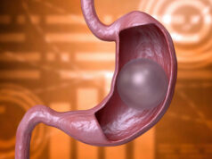 Управляемый воздушный шарик в желудке безвредно снижает количество съедаемой пищи на 60 %