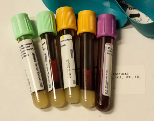 В Стэнфорде разработали анализ крови для определения скорости старения отдельных органов