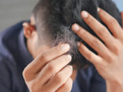 Натуральный подсластитель оказался необычайно полезным в борьбе с мужским облысением