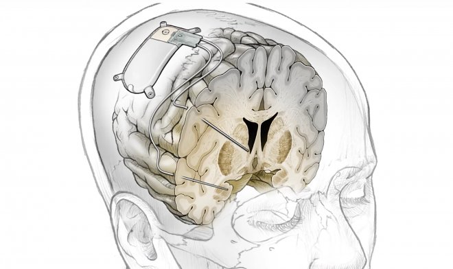 Экспериментальный мозговой имплант мгновенно избавит от неизлечимой депрессии 